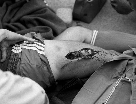 1981: Ewald Lienens Horrorverletzung (Bongarts/Getty)